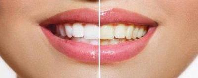 Before And After photo of stained and white teeth.