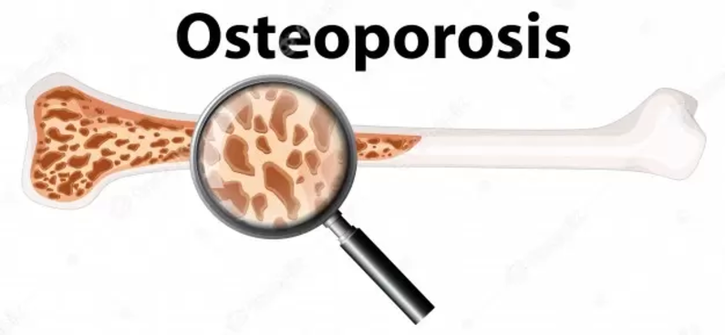 The Most Effective Way To Treat And Prevent Osteoporosis