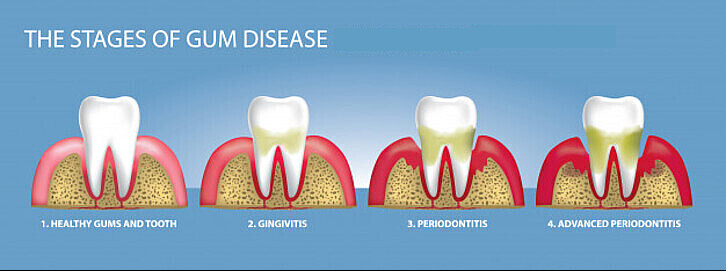 Stages Of Gum Disease And Bone Loss