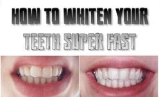 Whiten Teeth Fast And Naturally